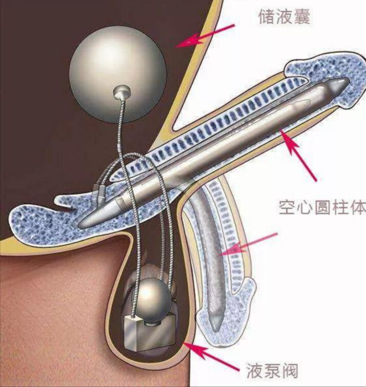 包含男性勃起功能障碍科普的词条-第2张图片-印淘网 包含男性勃起功能障碍科普的词条-第2张图片-印淘网